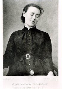 İstemsiz blefarospazm, Profesör Jean Martin Charcot (1825-93) tarafından Paris